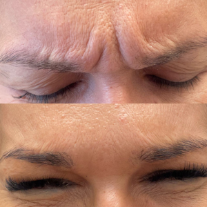 Botox Glabela
