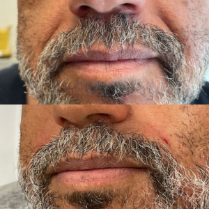 Botox Bigode Chinês
