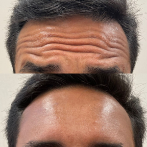 Botox Testa