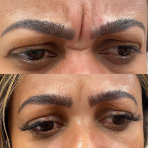Botox Glabela