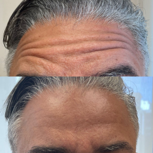 Botox Testa